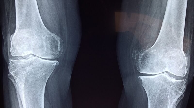 knee, x-ray, medical